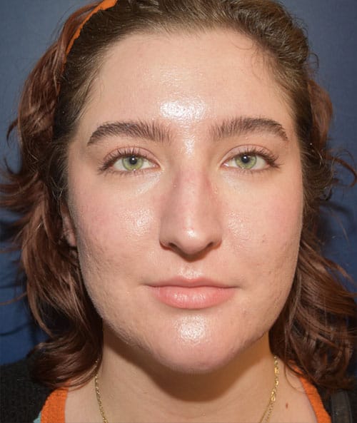 Rhinoplasty