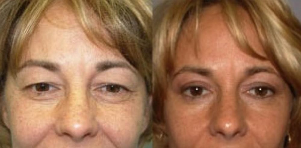 Before and after eyelid surgery with Cincinnati plastic surgeon Dr. Mark Mandell-Brown