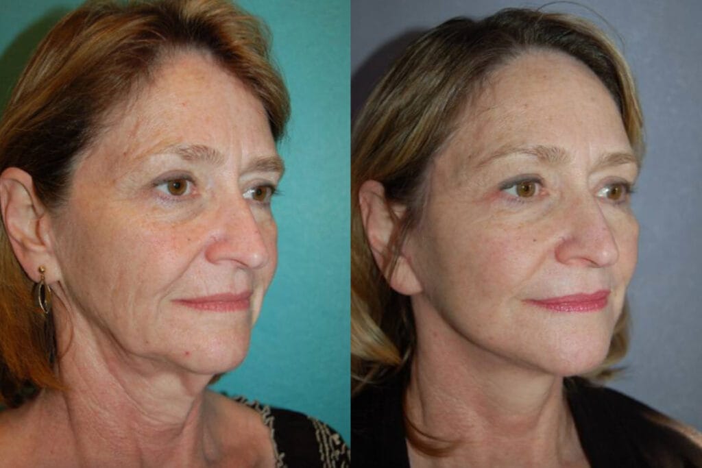 Before and after facelift with Cincinnati plastic surgeon Dr. Mark Mandell-Brown