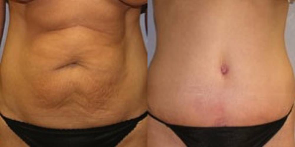 Before and after tummytuck with Cincinnati plastic surgeon Dr. Mark Mandell-Brown