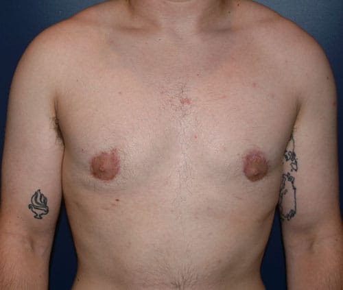 Transgender Top Surgery