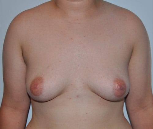 Transgender Top Surgery