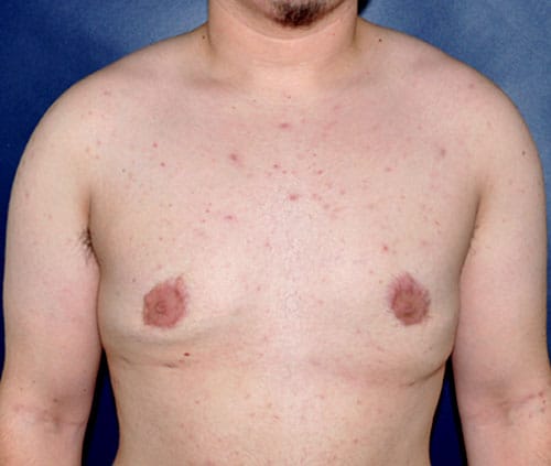 Transgender Top Surgery