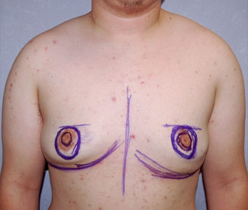 Transgender Top Surgery