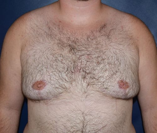 Transgender Top Surgery