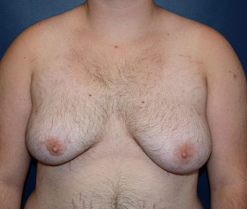 Transgender Top Surgery