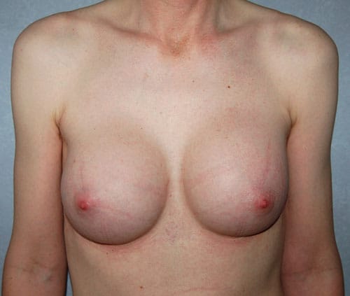 Transgender Top Surgery