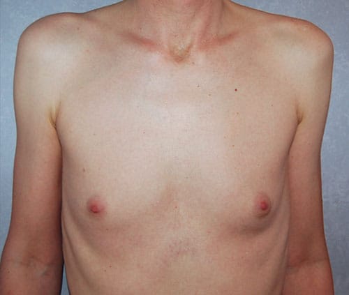 Transgender Top Surgery
