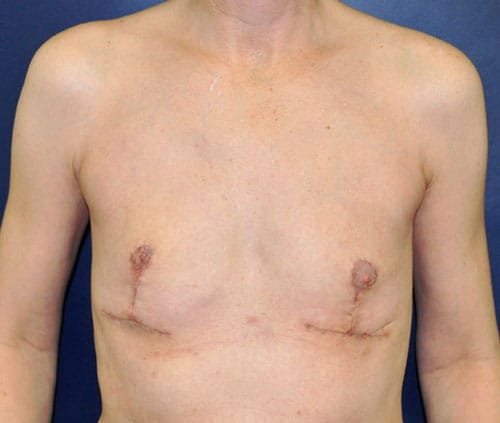 Transgender Top Surgery