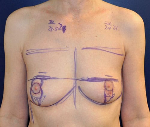 Transgender Top Surgery