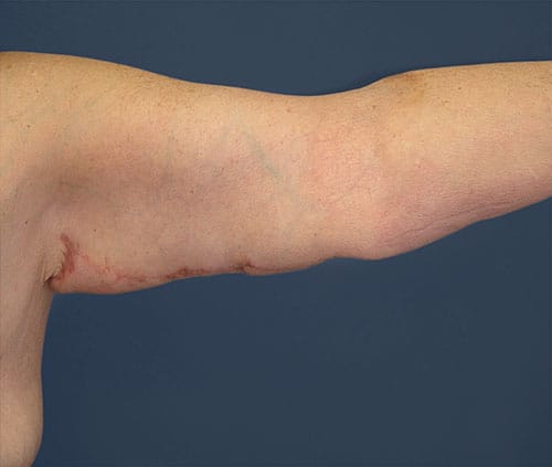 Arm Lift