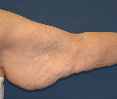 Arm Lift