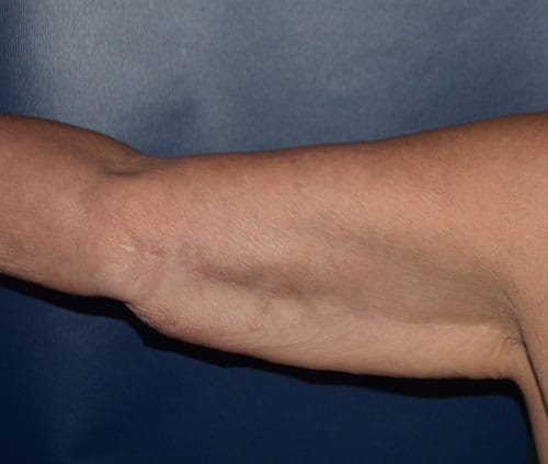 Arm Lift