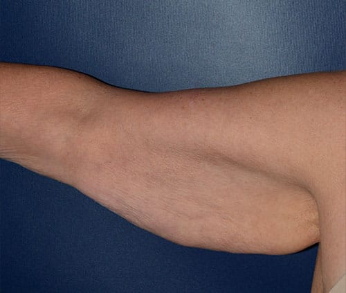 Arm Lift