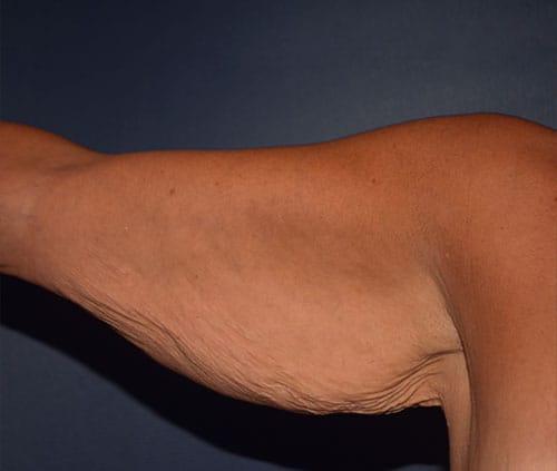 Arm Lift
