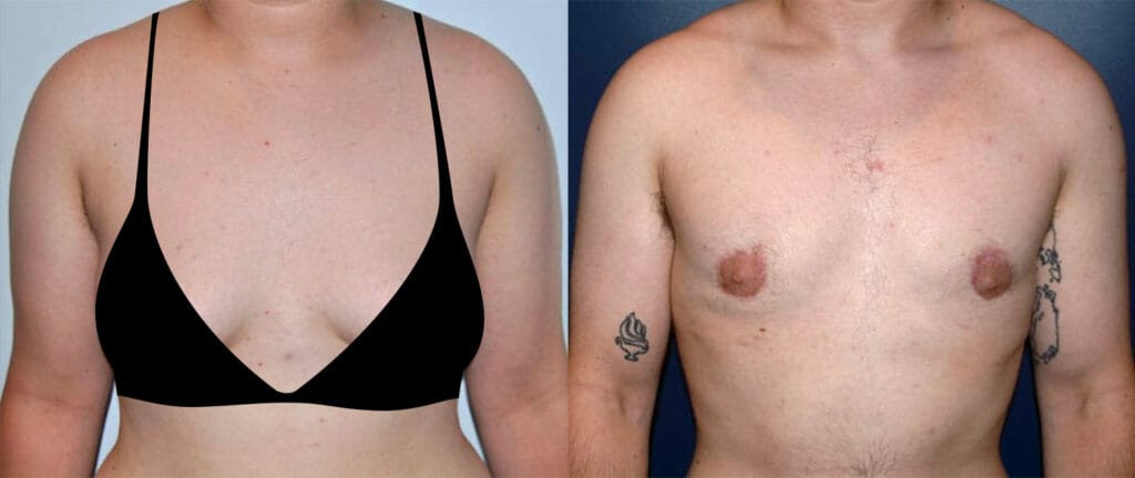 Before and after transgender female to male FTM top surgery with Cincinnati gender affirmation surgeon Dr. Mark Mandell-Brown