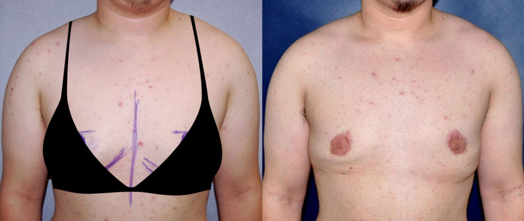 Before and after transgender female to male FTM top surgery with Cincinnati gender affirmation surgeon Dr. Mark Mandell-Brown