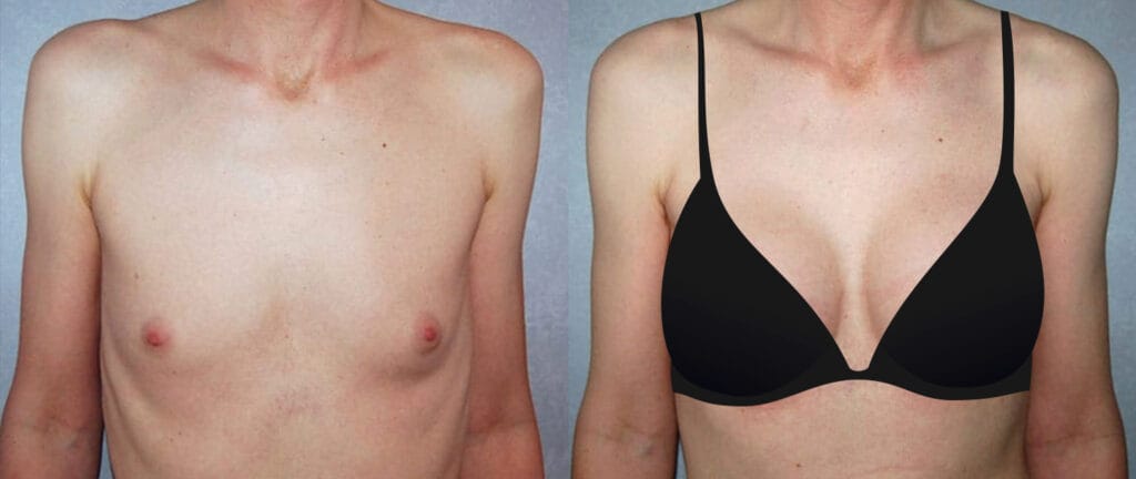 Before and after transgender male to female MTF top surgery with Cincinnati gender affirmation surgeon Dr. Mark Mandell-Brown
