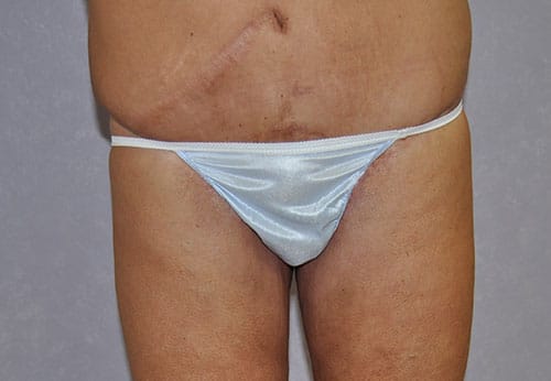 Thigh Lift