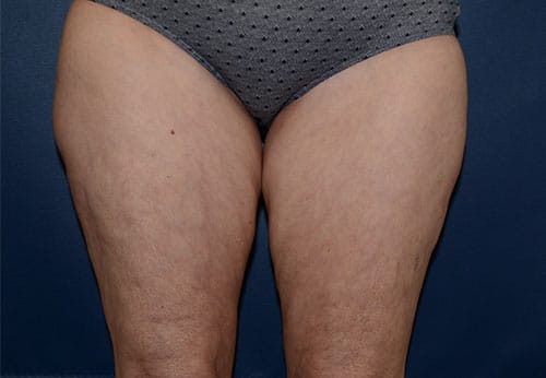 Thigh Lift