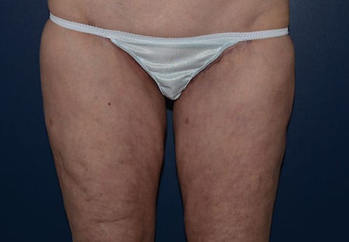 Thigh Lift