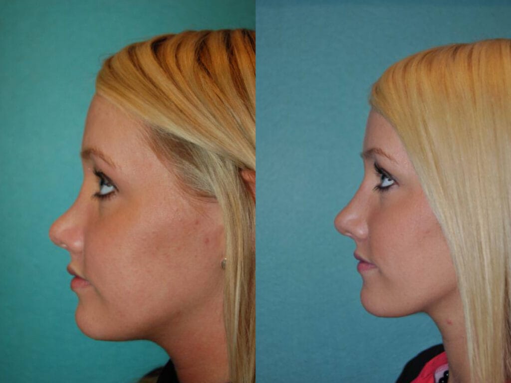 Female patient of Dr. Mark Mandell-Brown shown before and after revision rhinoplasty to correct the over-reduction of nasal hump