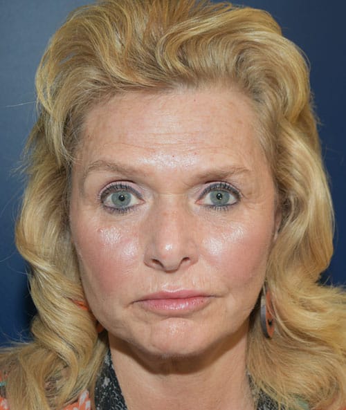 Natural Facelift