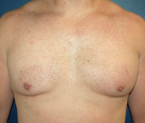 Male Breast Reduction