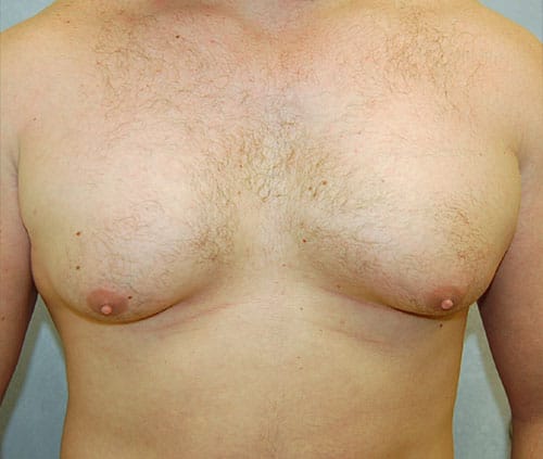 Male Breast Reduction