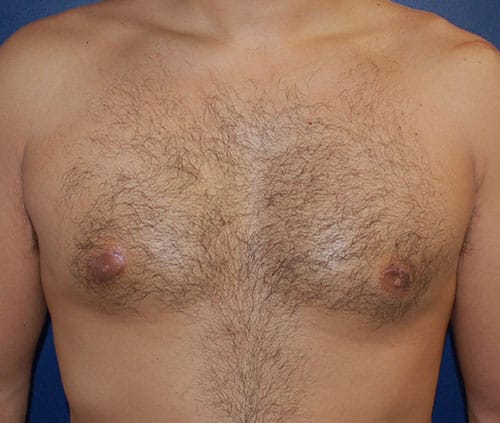 Male Breast Reduction