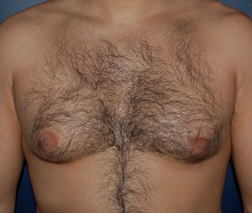 Male Breast Reduction