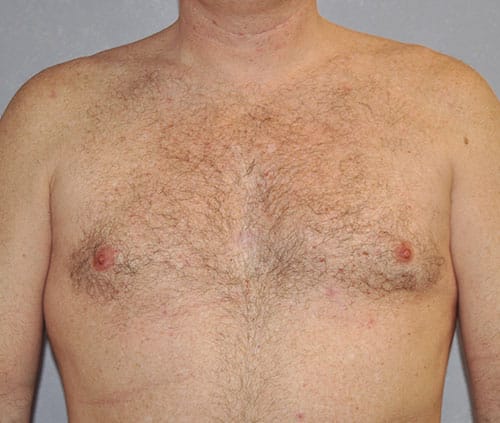 Male Breast Reduction