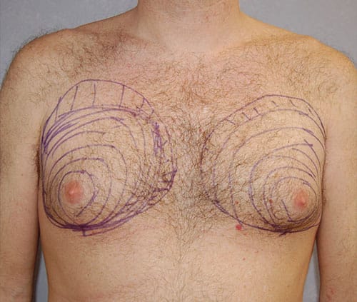 Male Breast Reduction