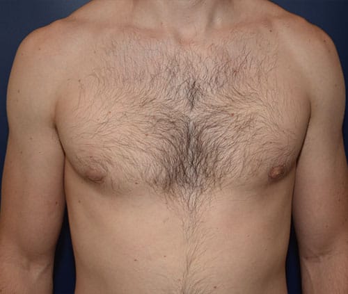 Male Breast Reduction