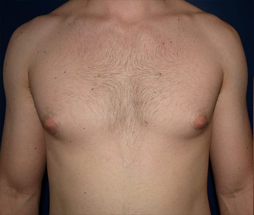 Male Breast Reduction