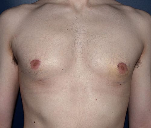 Male Breast Reduction