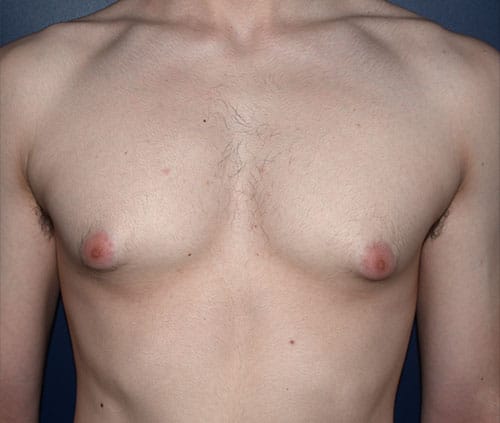 Male Breast Reduction