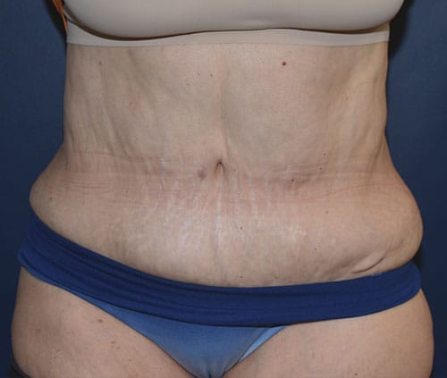 Tummy Tuck 121