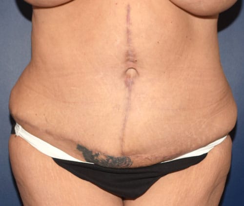 Tummy Tuck