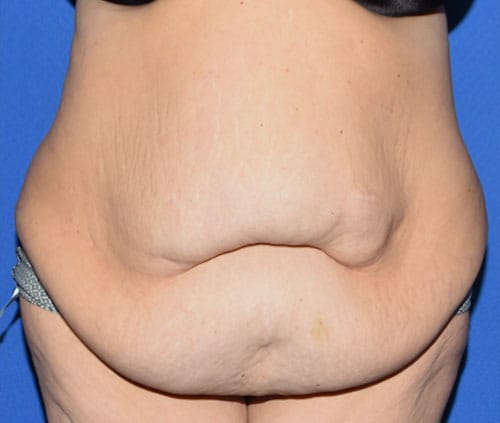 Tummy Tuck