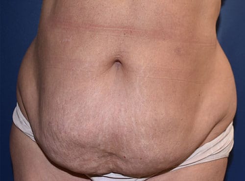 Tummy Tuck