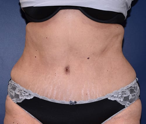 Tummy Tuck