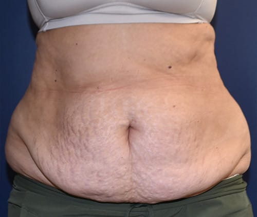 Tummy Tuck