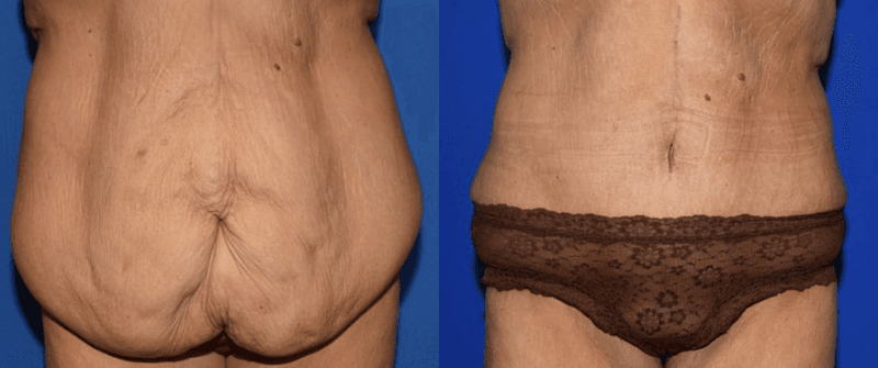 Before and 6 months after a fleur-de-lis tummy tuck with improved belly button with Dr. Mark Mandell-Brown