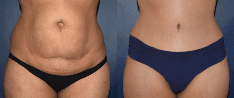 Before and 6 months after a tummy tuck with Dr. Mandell-Brown