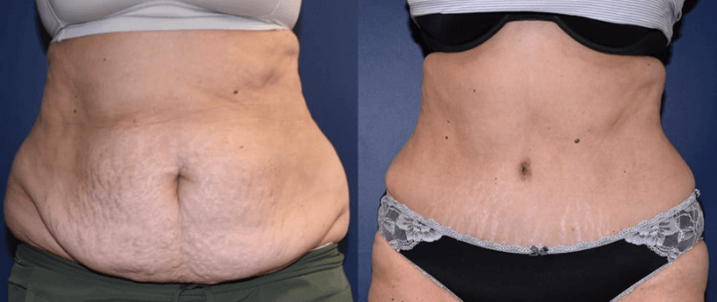 Before and 8 months after a full tummy tuck with Dr. Mandell-Brown
