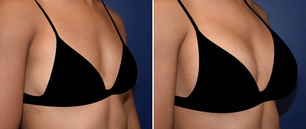 Before and after A-cup to C-cup breast augmentation
