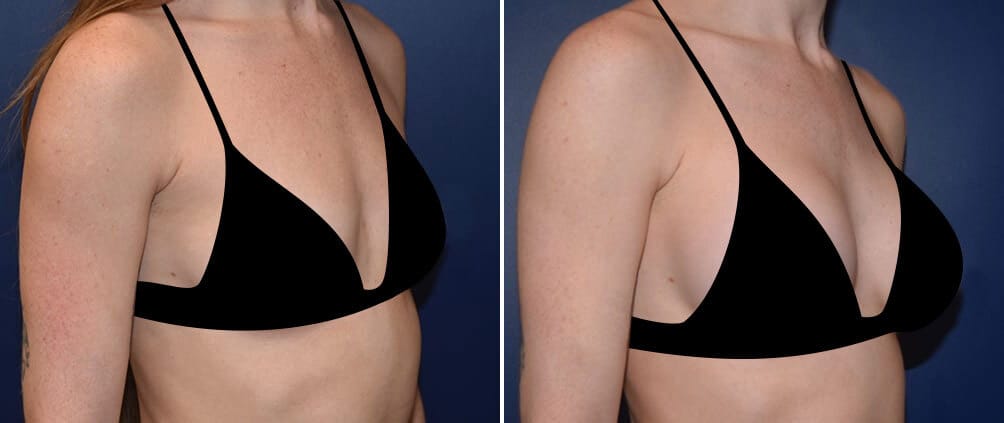 Before and after breast augmentation with Mentor 275cc High Profile Silicone Implants