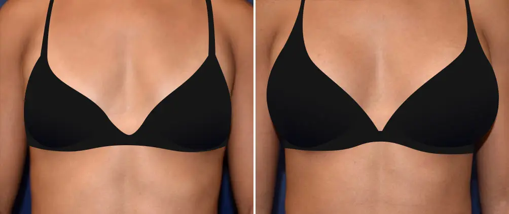 Mandell-Brown Plastic Surgery Breast Augmentation Before and After Patient Results