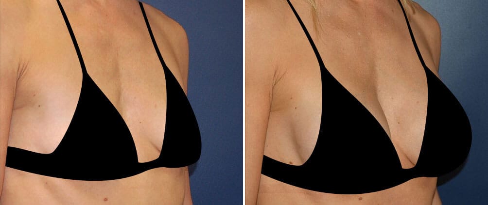 Before and after A-cup to D-cup breast implants